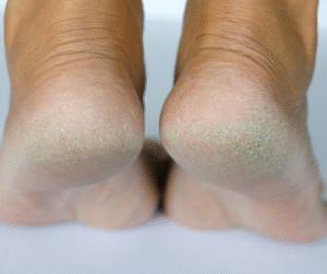 Can Thyroid Problems Make Heel Pain Worse?
