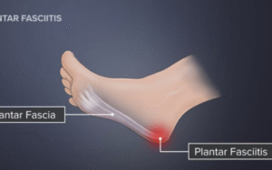 Symptoms of Plantar Fasciitis
